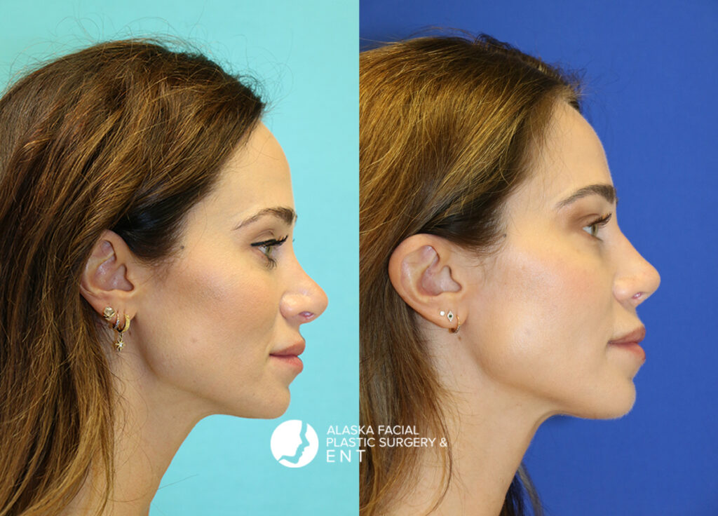 Rhinoplasty & Revision Rhinoplasty 6 - Alaska Facial Plastic Surgery & ENT