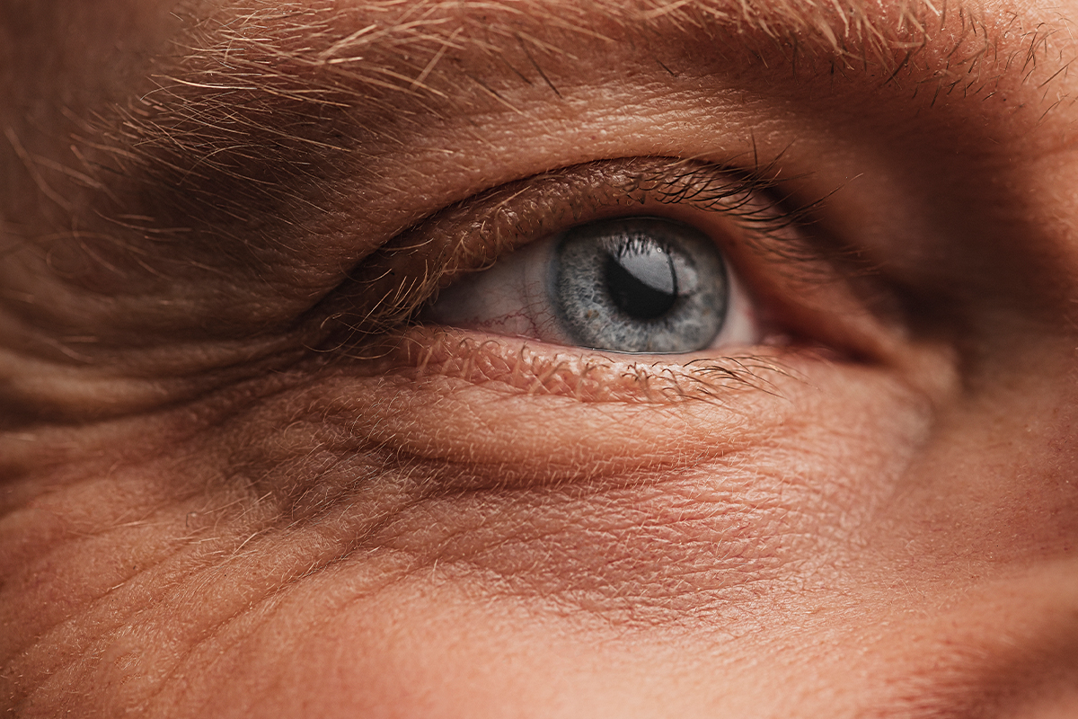 An eye of a person getting a blepharoplasty in Anchorage.