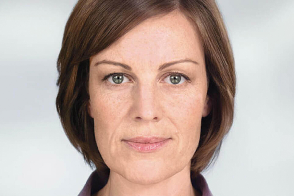 Woman after Sculptra in Anchorage.